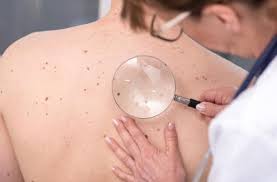 Elle indique que le dépistage du cancer du sein a entraîné 22 % de surdiagnostics. Cancer De La Peau Comment Reconnaitre Un Grain De Beaute A Risque