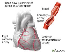 An aortic aneurysm can lead to an aortic dissection chest pain associated with anxiety attack: Coronary Artery Spasm Medlineplus Medical Encyclopedia