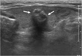 Small flecks of calcium within a thyroid nodule, usually seen as small bright. Echogenic Foci In Thyroid Nodules Diagnostic Performance With Combination Of Tirads And Echogenic Foci Bmc Medical Imaging Full Text