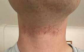 How To Stop Bad Skin Irritation On Neck After Shaving? : R/Shaving