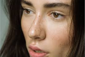 Image result for Freckled skin