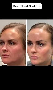 #botox #botoxfacial #Botox #botoxcapilar #funny