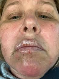 Lupus patient suffers severe sunburn