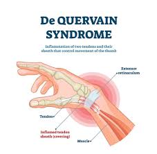 Image result for Tendon Sheath Injection