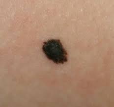 Image result for Spitz Nevus