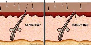 They can appear on the scalp in those who shave their heads. Ingrown Hair On Head Scalp Pictures Symptoms Removal Treatment