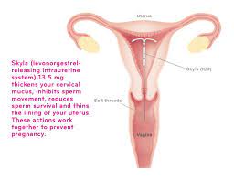 The more intense pain usually eases off after a couple weeks but you may still have random cramps (and for you that means lower back pain) for the first few months. What Is Skyla Skyla Us Patient
