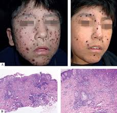 Scielo Brasil Epstein Barr Virus And Skin Epstein Barr Virus And Skin