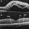 Retinal holes and tears are commonly encountered during dilated fundus examination of both symptomatic and asymptomatic patients. Https Encrypted Tbn0 Gstatic Com Images Q Tbn And9gctlxdl6tycqua7 Vrwkaoeyywaoddeos8ryrb4fb0 Npz2ygbie Usqp Cau