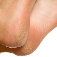 Aside from looking like a changing mole, a melanoma on the foot can appear as a: 6 Ways Menopause Causes Foot Pain Plus The Best Solutions