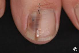 Image result for Acral lentiginous melanoma nail