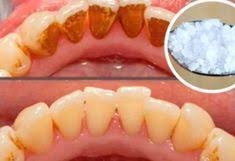 Ce Bain De Bouche Fait Maison Elimine La Plaque Dentaire En 2 Minutes Esprit Sante Detartrage Des Dents Detartrer Dents Plaque Dentaire