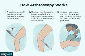 A step by step meniscus tear treatment plan with 4 exercises to cure your meniscus naturally and in today's post, i'll show you exactly how i treat my patient's meniscus tears successfully in our meniscus tear treatment testimonial. Meniscectomy Preparation To Recovery