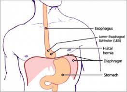Hiatal Hernia Portland Clinic Of Holistic Health Holistic Medical Group