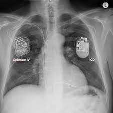Icd steht für implantable cardioverter defibrillator, ein gerät, das wie ein herzschrittmacher implantiert wird. Implantationen Umm Universitatsmedizin Mannheim