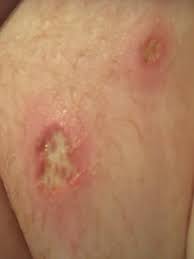 You might be born wi. Mole Biopsy Site Does This Look Infected Dermatologyquestions