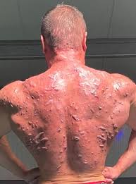 Adverse Reaction to Anabolic Steroids. : rawfuleverything