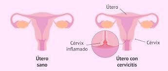 Maybe you would like to learn more about one of these? Que Es La Cervicitis Sintomas Diagnostico Y Tratamiento