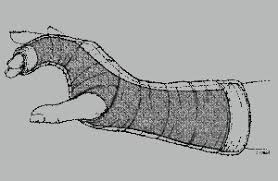 Image result for Radial Gutter Cast