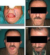 Segment gate with flap for the niederfinow boat lift, germany. Functional Reconstruction Of The Lower Lip With Fujimori Flap And Long Term Follow Up With Clinical And Electrophysiologic Evaluations Sciencedirect