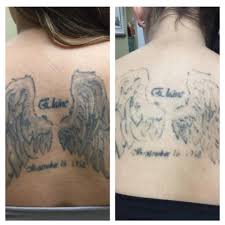 Much like many other tattoo removal methods, ipl can cause more harm than good when attempting to remove a tattoo from your skin. Before After Just One Session With Our Pico Technology Laser One More Session And She Is Ready For Her Cover U Tattoo Removal Cost Tattoo Removal Laser Tattoo