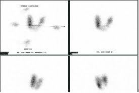 Cureus Radioiodine Therapy Induced Conversion Of Toxic Adenoma To Graves Disease