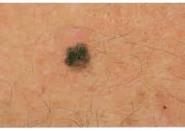 Hard lumps may appear in your skin. Melanoma Warning Signs And Images The Skin Cancer Foundation