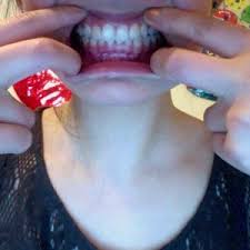 Used to aid in all types of orthodontic treatments, rubber bands are essential to braces. Rubber Bands With Invisalign Is It Too Late In The Process