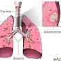 small cell lung cancer life expectancy from www.mountsinai.org