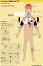 Signs And Symptoms Of Pulmonary Embolism Pe Pulmonary Grepmed
