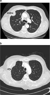 An mri scan uses magnetism to build up a detailed picture. Localized Malignant Mesothelioma An Unusual And Poorly Characterized Neoplasm Of Serosal Origin Best Current Evidence From The Literature And The International Mesothelioma Panel Modern Pathology