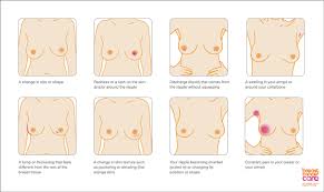 For women with a brca1 mutation, the risk of developing breast cancer by age 80 is 72%. This Lesser Known Breast Cancer Warning Sign Helped Save British Woman S Life National Globalnews Ca