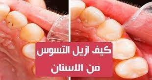 كيف ازيل التسوس من الاسنان العديد من الناس تشتكي من تسوس الاسنان وتريد علاج للتخلص من التسوس وهناك العديد من الاسباب التي تؤدي gummy candy peach rings gummies