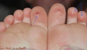 Image result for brown patches on the feet