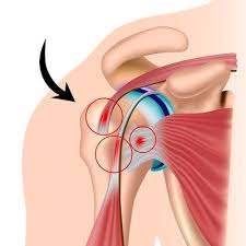 Image result for Rotator Cuff Tendonitis