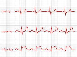 Heart Cardiogram Vector Charts Set Healthy Heart Stock