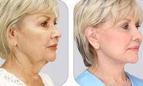 Pin On Tighten And Lift Turkey Wattle Neck Using Neck Toning Exercises
