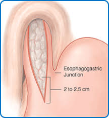 Most infectious gastroenteritis is viral, contagious and of short duration. Laparoscopic Heller Procedure Cardiomyotomy North Bristol Nhs Trust