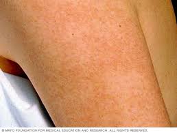 Image result for Keratosis pilaris