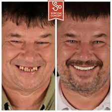 🔥Sobczak Concept®️🔥 Warszawa Pan Ryszard miał duży problem z paradontozą.  Wiele osób ma ten sam problem. Zęby zaczynają się ruszać, a potem wypadać.  W takiej sytuacji nie wolno czekać❗️ Trzeba działać❗️