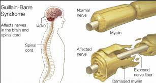 The us food and drug administration updated the label on johnson & johnson's coronavirus vaccine monday to warn of the possible increased risk of a rare neurological complication known as. Guillain Barre Syndrome Rmi