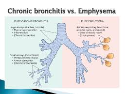 Learn the key differences between the two. Respiratory Block Pathology L 2 Introduction To Copd