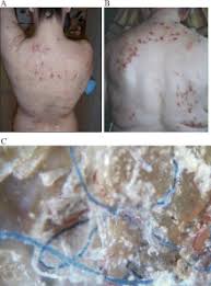 La maladie de lyme est une maladie facile à traiter. Morgellons Wikipedia