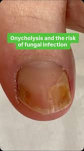 Image result for Onycholysis feet