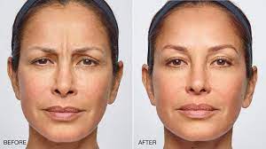 After five rounds of treatment, that increased to about 70% of the people. Best Botox Miami Rotemberg Plastic Surgery