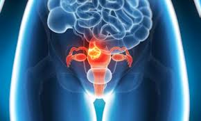 You may discuss with your teen's doctor to know the stages, substages, and the required treatment and outcome of ovarian cancer in teenage groups. Embarrassing Symptoms Could Be Deadly Female Cancer Daily Mail Online