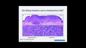 Eligibility also required evidence of bap1 inactivation (loss of nuclear staining or loss of expression of bap1 protein) or. Genetics And The Bap1 Gene In Mesothelioma Mesothelioma Applied Research Foundation