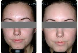 Blu U Blue Light Photodynamic Therapy Upper West Side Dermatology