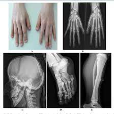 His parents were first cousins. Pdf Toulouse Lautrec Disease A Case Report Of A Femur Shaft Fracture Semantic Scholar