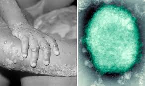 However, it is much more common among animals such as rats, mice, rabbits, and the african squirrel. Monkeypox Symptoms What Is Monkeypox What Are Symptoms Express Co Uk